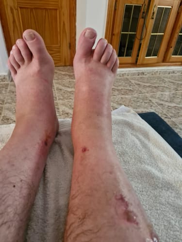 image 2 out of 2: Customer photo review of Premium Bamboo Ankle Support