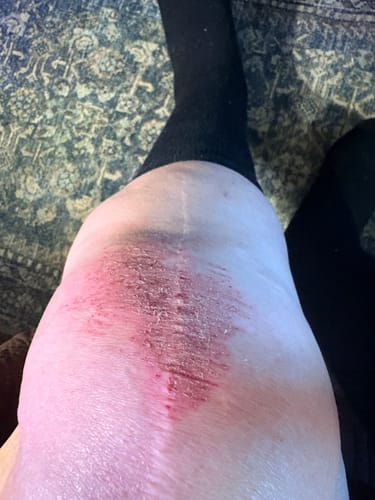 image 2 out of 2: Reviewer's leg wearing a black Premium Bamboo Leg Sleeve, showing skin irritation on the knee