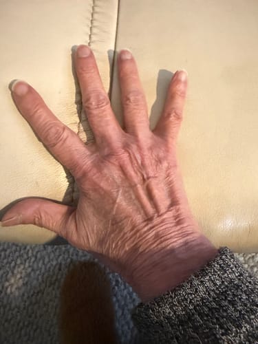 image 2 out of 3: Reviewer's hand held open, showing improved finger straightening after using the gloves.