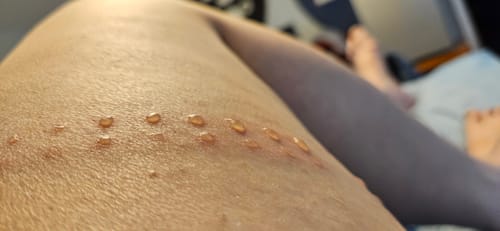 Reviewer's skin with small red circular marks or blisters on the upper thigh after using the Premium Bamboo Leg Sleeve.